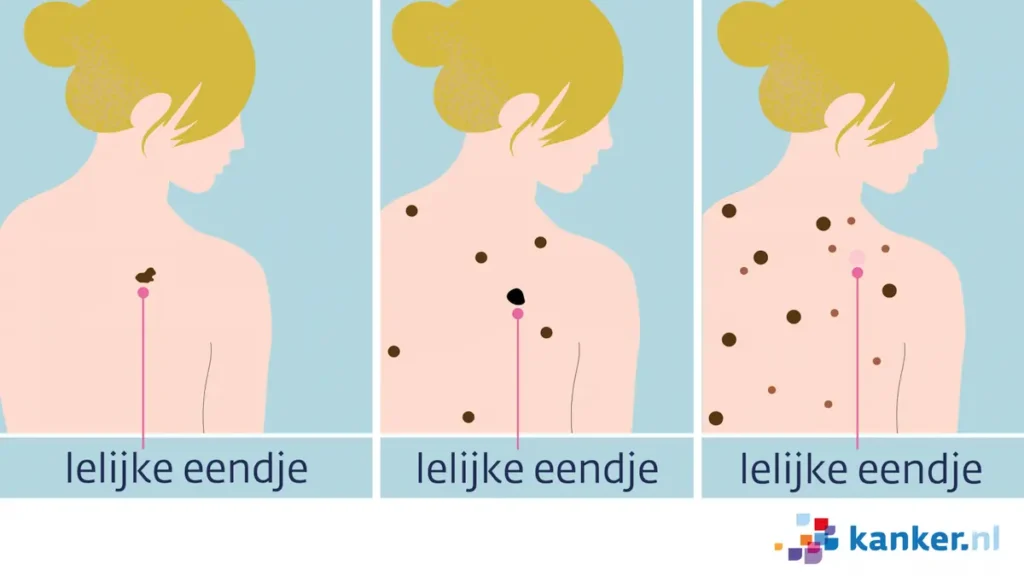 Lelijk eendje. Herken een melanoom