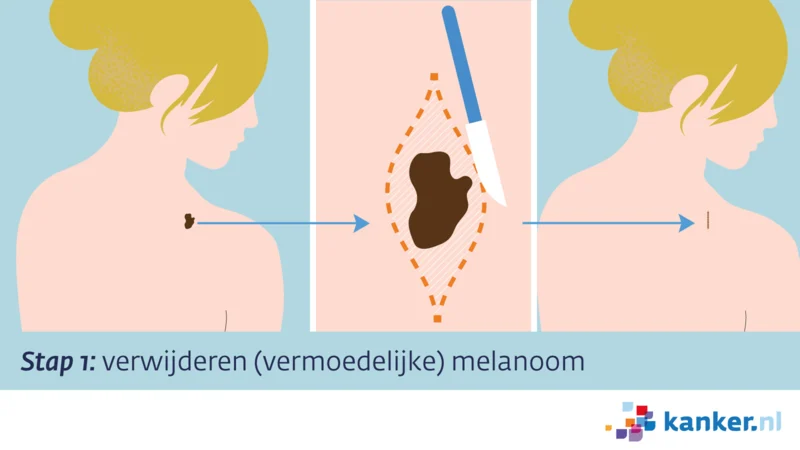 Verwijderen melanoom verdachte afwijking