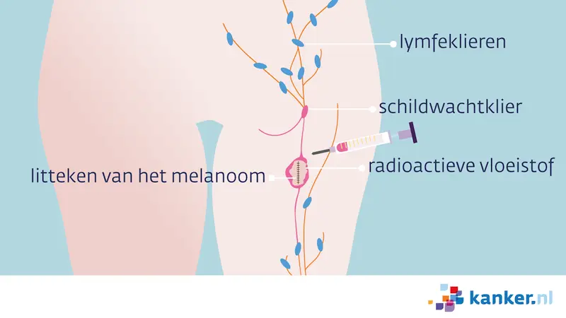 Schildwachtklier procedure