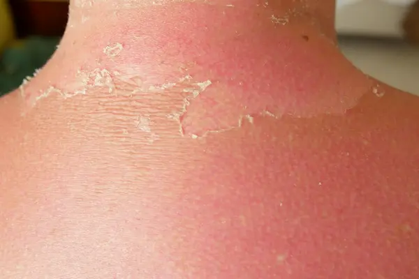 zonnebrand